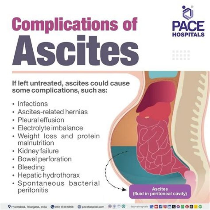 What parasite causes ascites?