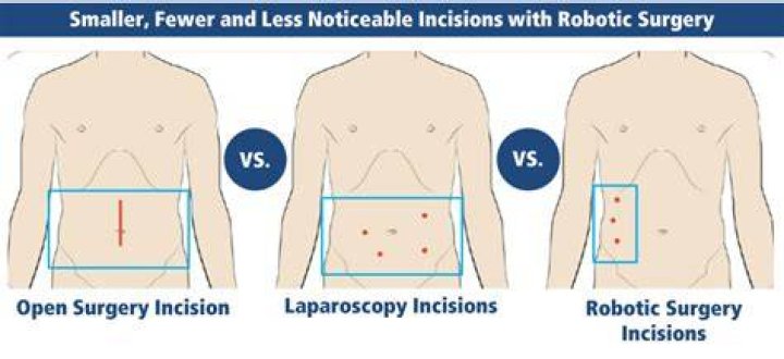 Where are the incisions for laparoscopic hernia surgery?