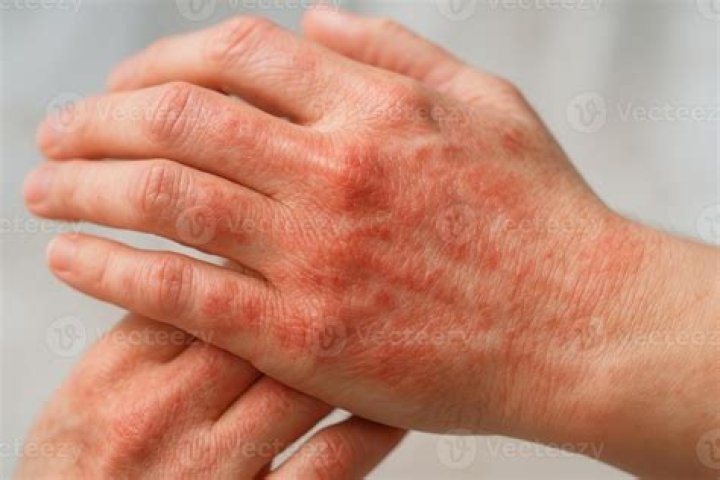Why are my hands always red and burning?
