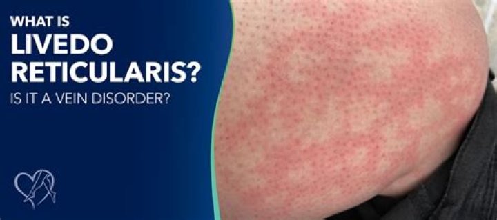 Why does livedo reticularis happen?