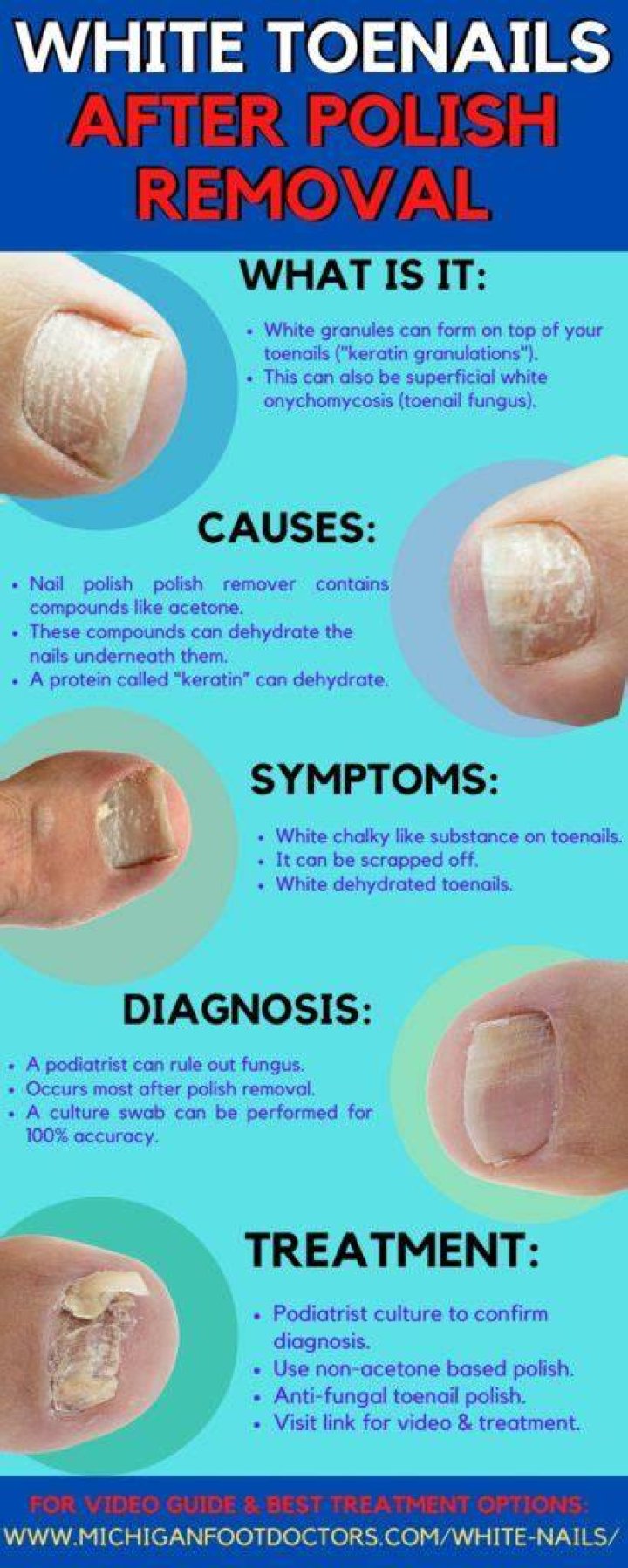 Why is the top of my nail really white?